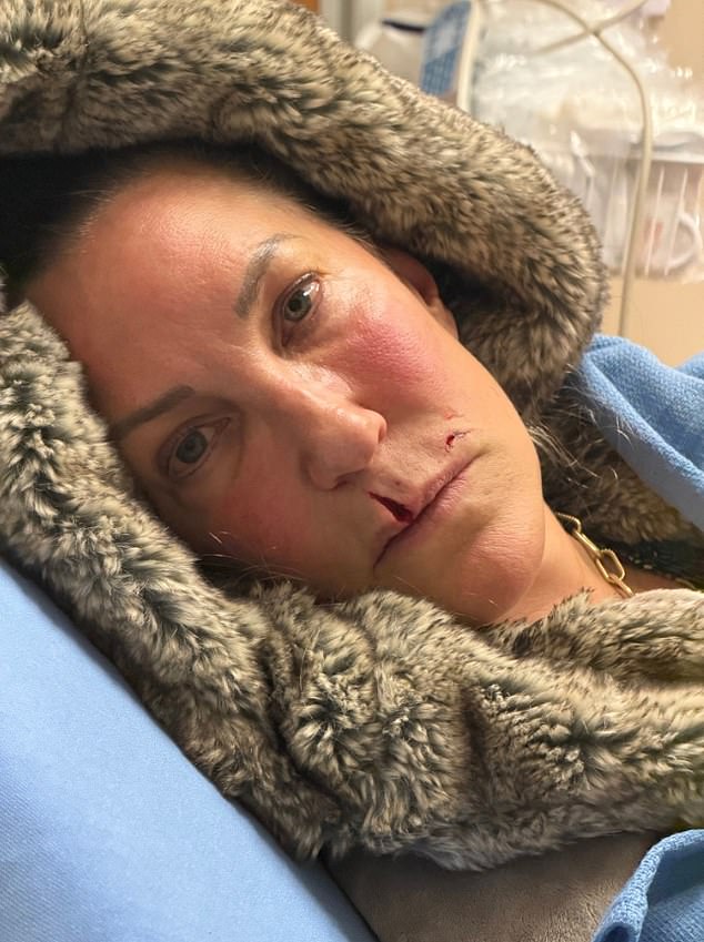 Brenda Calcavecchia at a Florida hospital after a bite from the family Jack Russell, Lucie