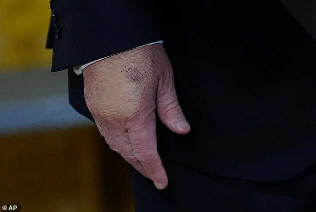 Close-up of Trump's hand showing visible bruising on May 6