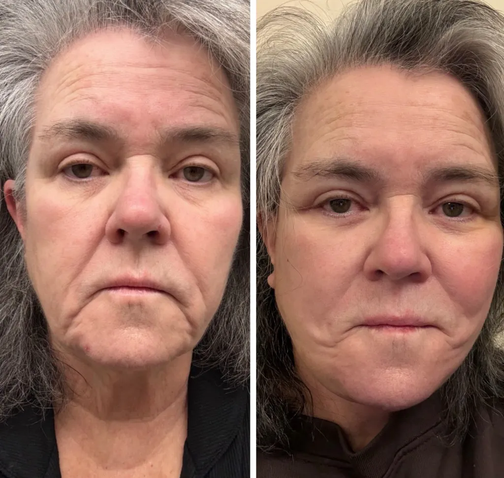Side-by-side before-and-after photos Rosie O'Donnell shared of her facelift.